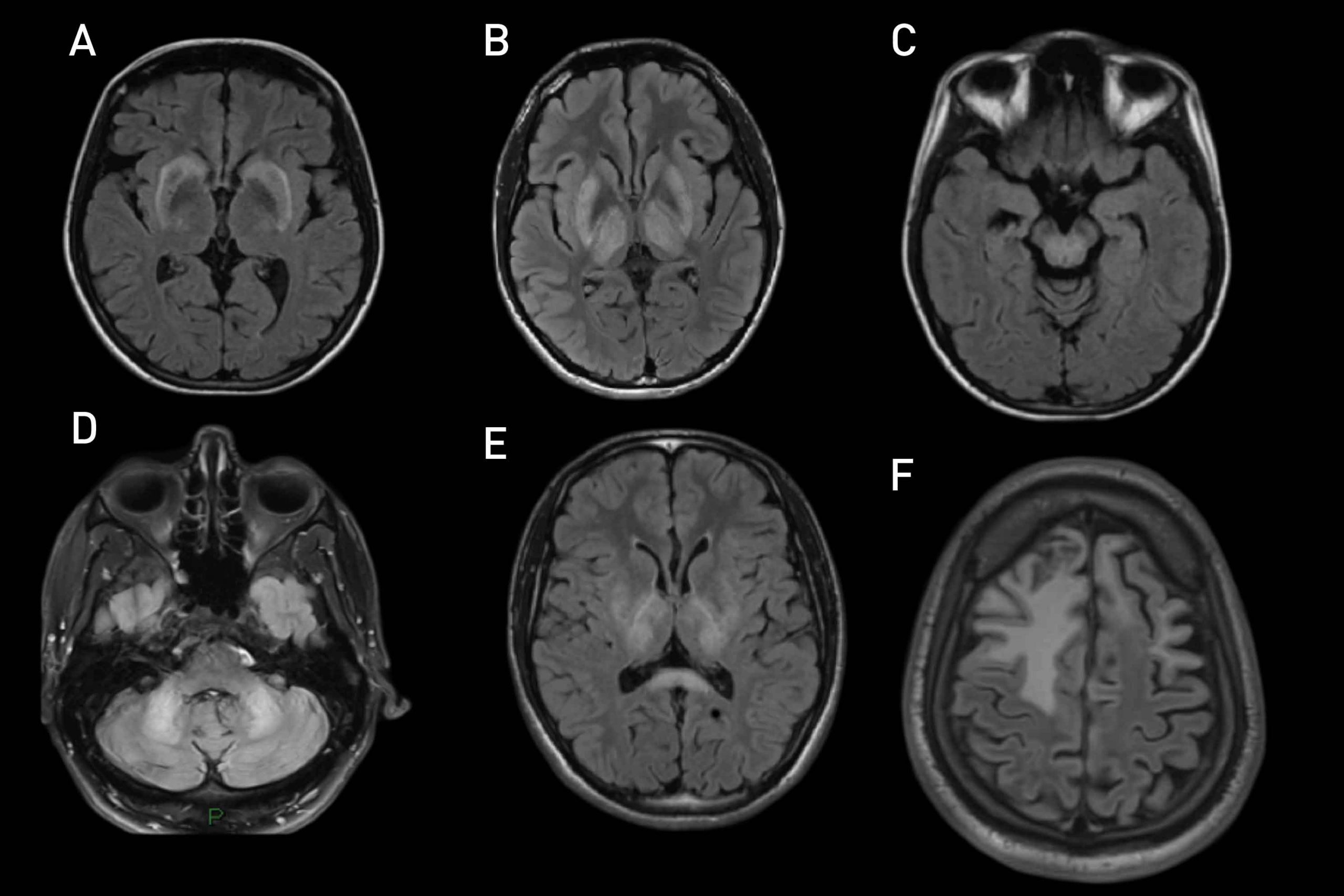 La Maladie de Wilson actualités Neurologies