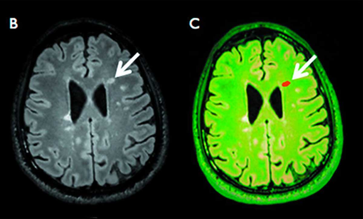Formes progressives de sclérose en plaques : place actuelle de l’IRM pour le diagnostic positif et différentiel