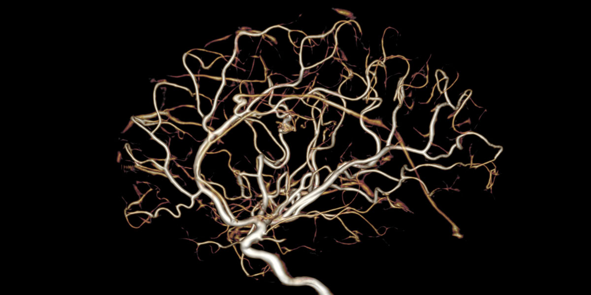 Congrès de la SFNV 2019 : l'actualité en neurovasculaire
