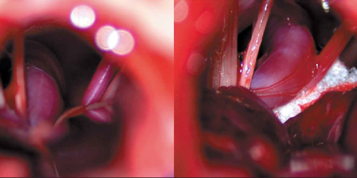 Le traitement du spasme hémifacial primaire : la place de la chirurgie