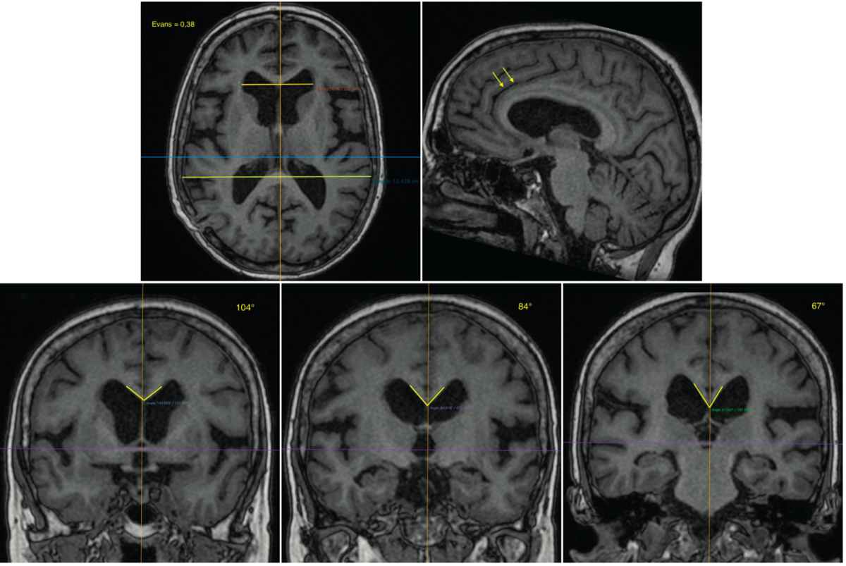 L’hydrocéphalie chronique de l’adulte, ou hydrocéphalie « à pression normale » Neurologies