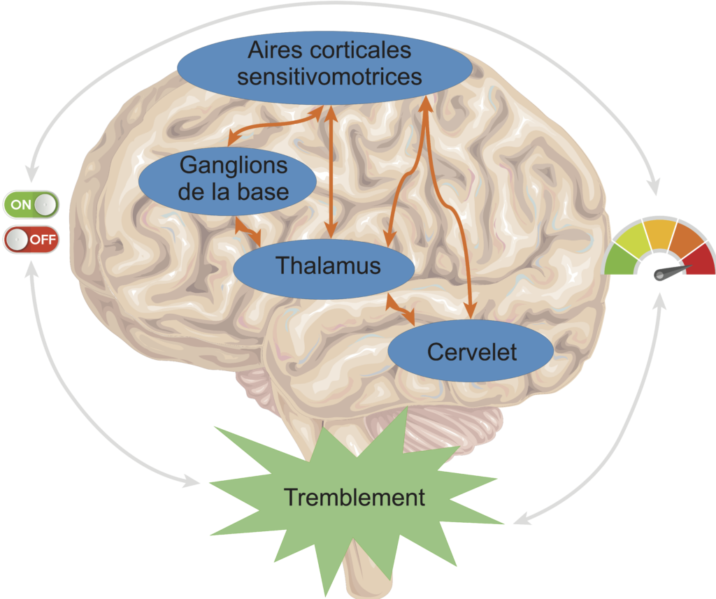 New Interventional Approaches for Tremor Management - News Directory 3